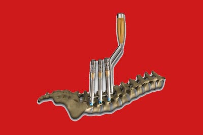 spinal implant