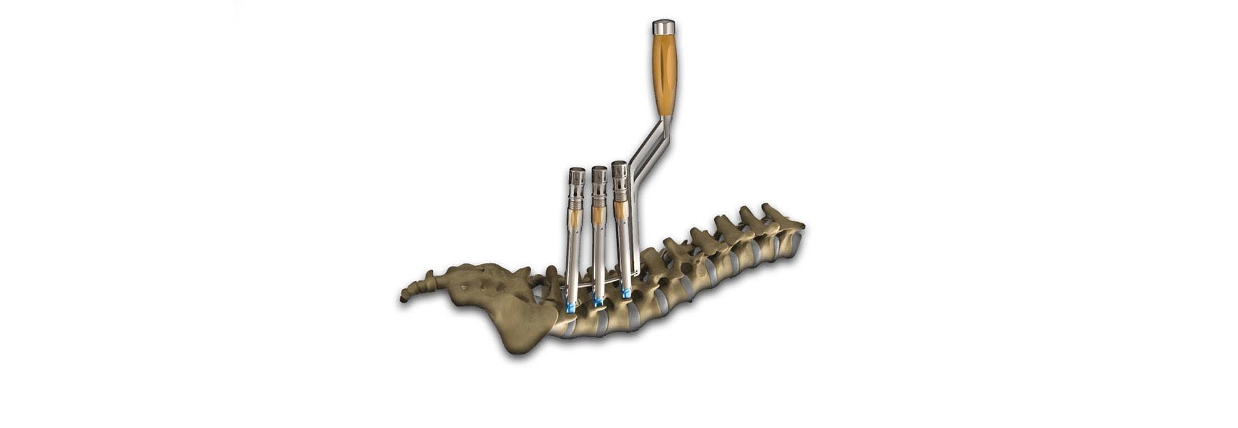 orthopedic implant