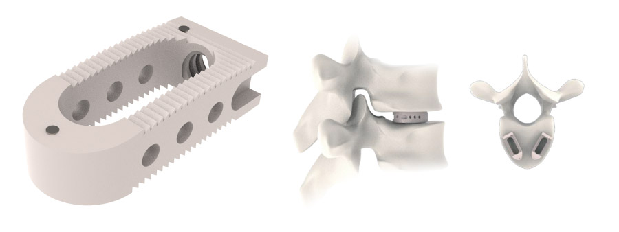 Spinal implant Alligator Plif Peek Cage