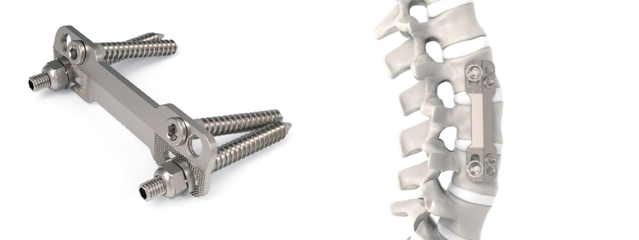 Spinal implant Armada Anterior Thoracolumbar Plate System