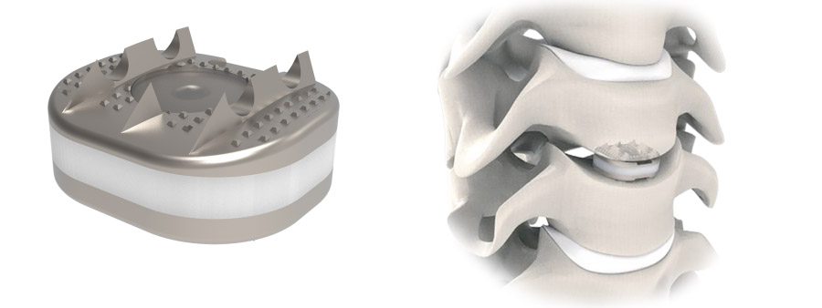 Spinal implant Trimi Anterior Cervical Plate System