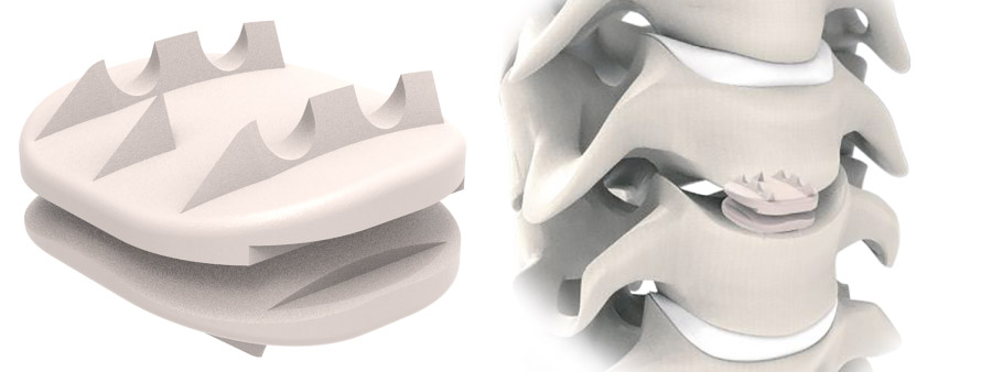 Spinal implant D-Motion Peek Cervical Disc Prosthesis