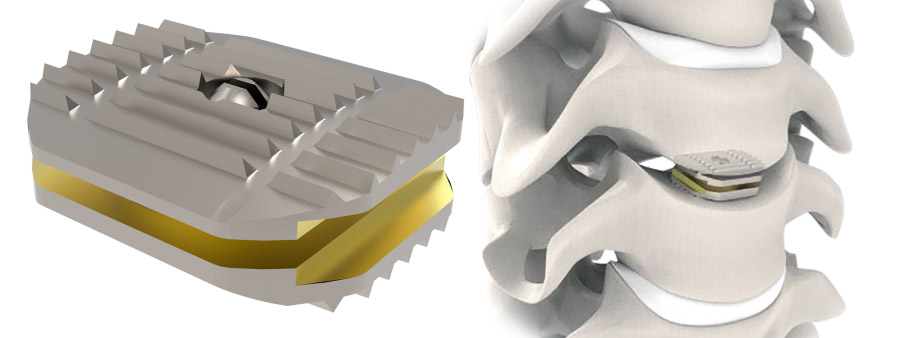 Spinal implant D-Pro Titanium Cervical Disc Prosthesis