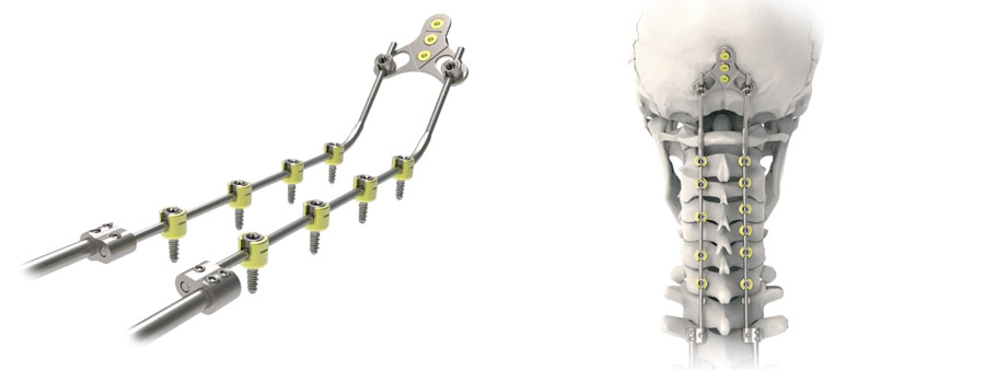 Spinal implant Oxis Plus Occipitocervical Fixation System