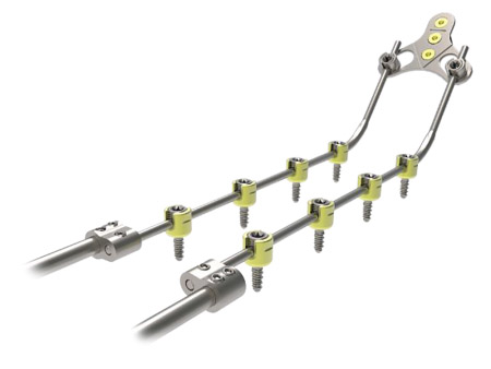 Spinal implant Oxis Plus Occipitocervical Fixation System