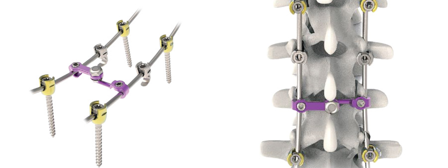 Spinal implant Pedifix Posterior Thoracolumbar Fixation System