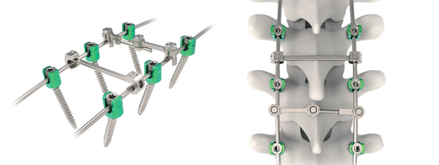 Spinal implant Rapidfix Dual Lead Thoracolumbar Screws