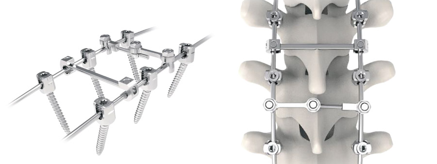 Spinal implant Silver Posterior Thoracolumbar Fixation System