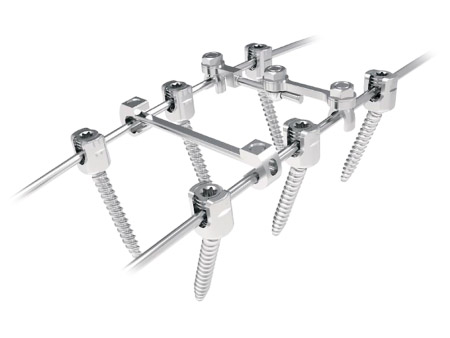 Spinal implant Silver Posterior Thoracolumbar Fixation System