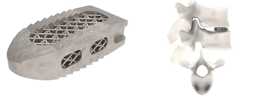 Spinal implant Tra-Ti Trabecular Plif Cage