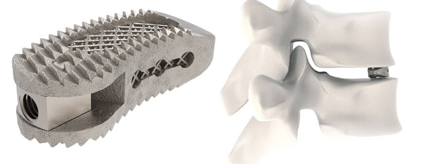 Spinal implant Tra-Ti Trabecular Tlif Cage