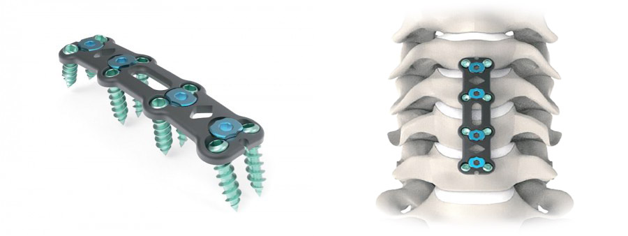 Spinal implant Trimi Anterior Cervical Plate System