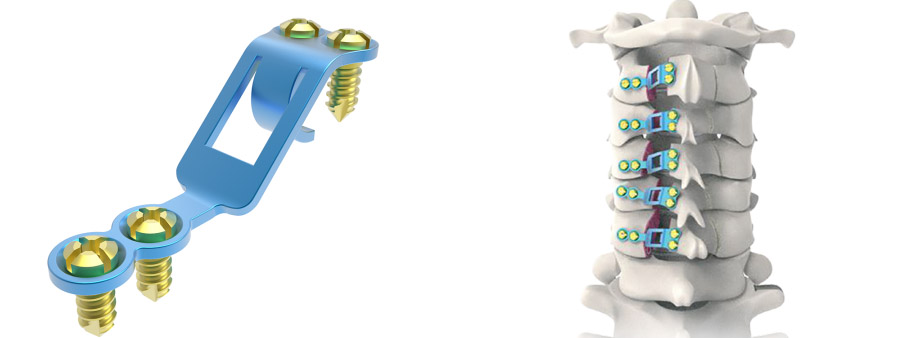 Spinal implant Z-Rhythm Laminoplasty Plate System