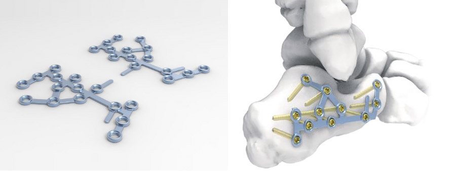 Trauma Plate Calcaneal Locking Plate