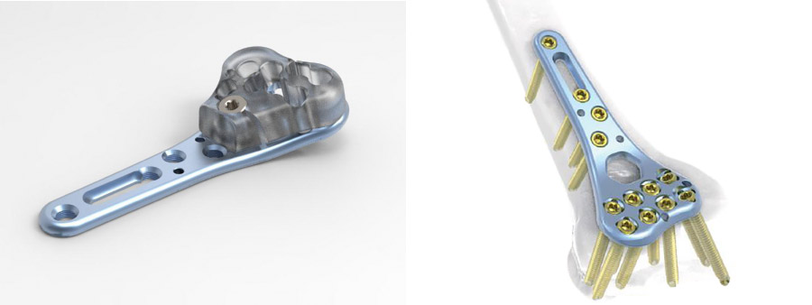 Trauma Plate Distal Volar Radius Locking Plate