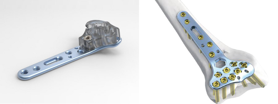 Trauma Plate Distal Volar Radius Rim Locking Plate