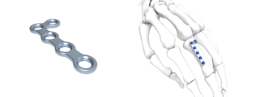 Trauma Plate L Right Hand&Foot Plate