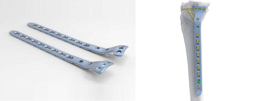 Trauma Plate Proximal Medial Tibial Locking Plate